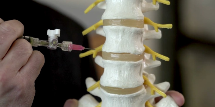 Una nuova tecnica riempie e ripara i dischi tra le vertebre