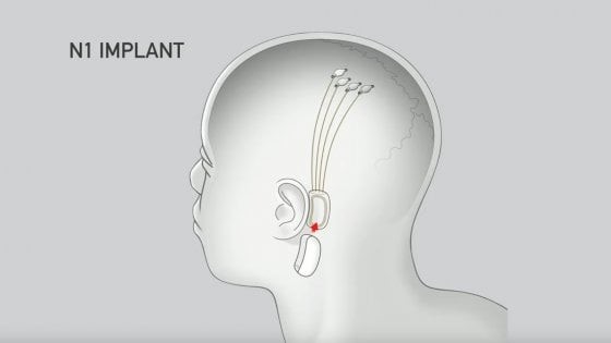 neuralink collegamento uomo macchina