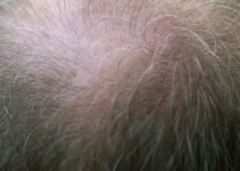 LLLT Laser, il cappello di Xiaomi contro la calvizia