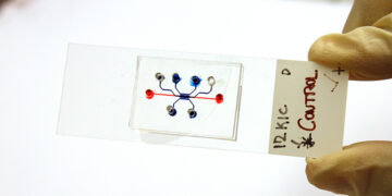 Cancro al pancreas, nuovo test multiplo con microfluidi